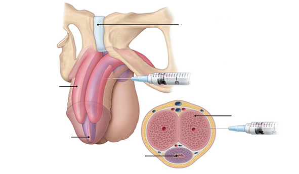 Injecting your own fat tissue for penis thickness